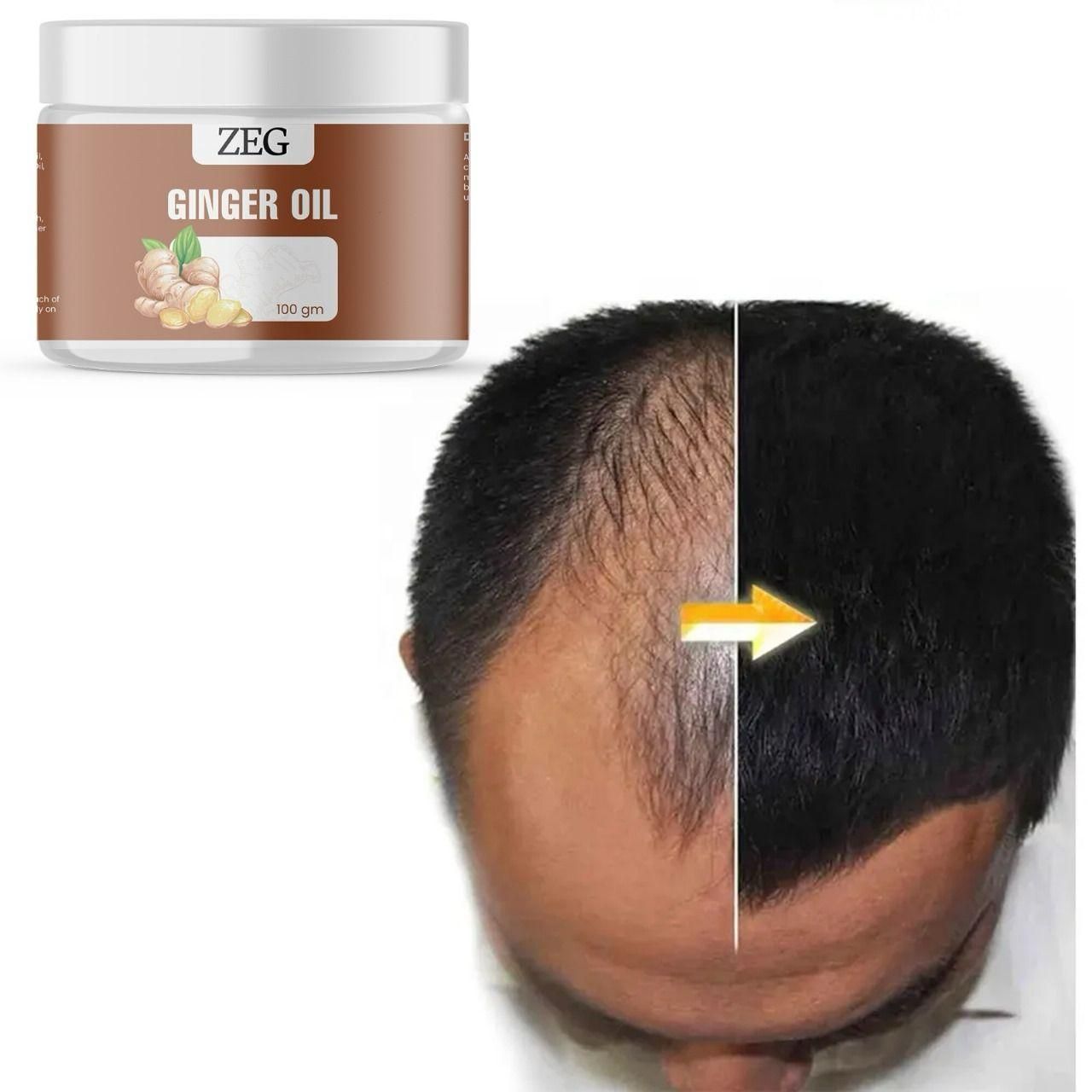100% Dandruff Removal ZEG GINGER OIL Natural Multipurpose Oil !